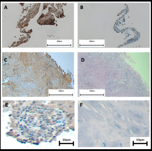 Inmunohistoquímica para EBNA1 en carcinomas pulmonares de Chile, con controles positivos y negativos. La señal marrón identifica EBNA1; los paneles conservan las barras de escala originales.